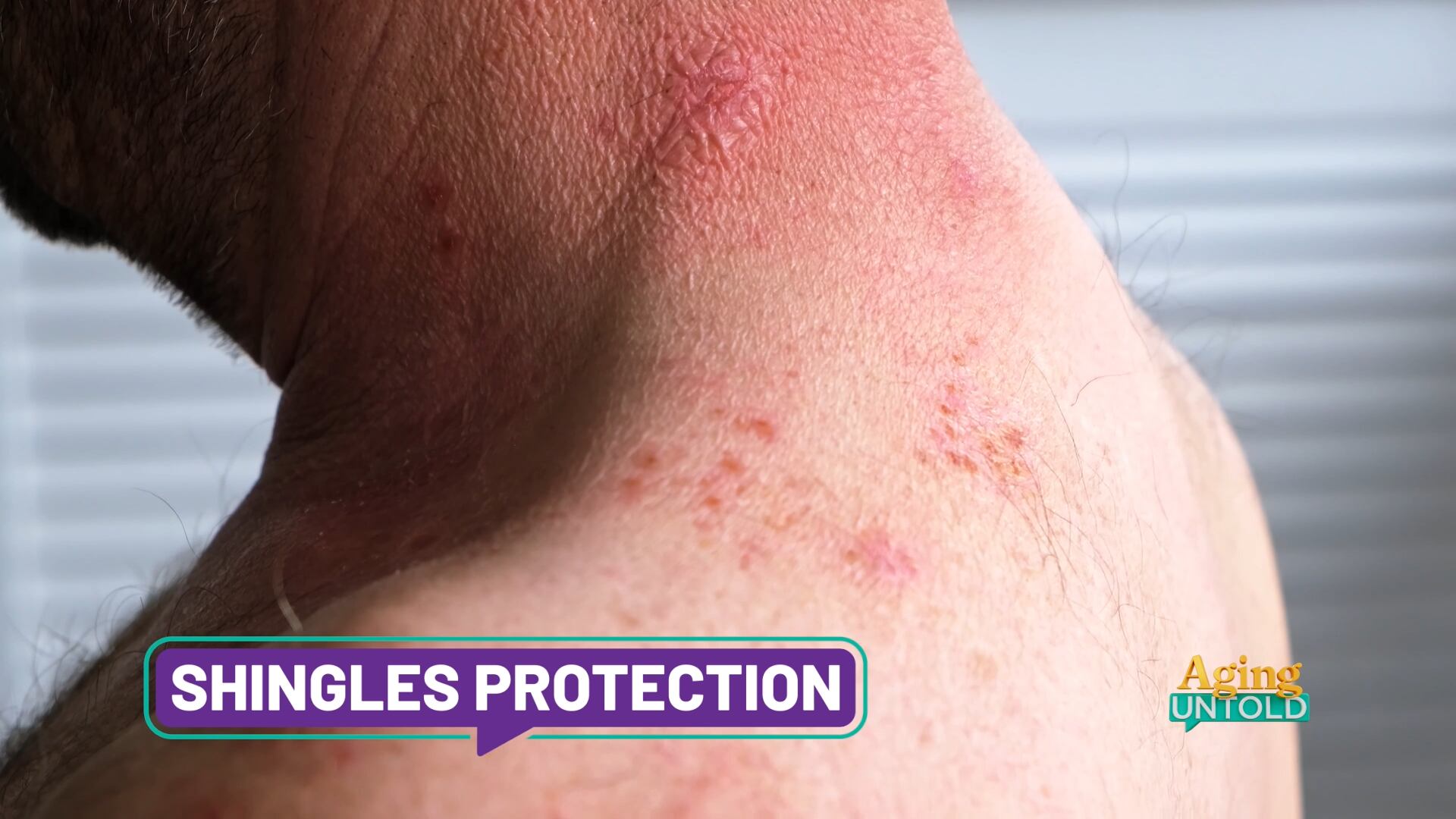 ‘Bad houseguest’ in the attic: What to know about shingles symptoms and treatments